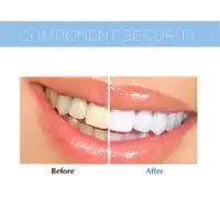 Teeth Whitening Device whitening tray setup Techs Park